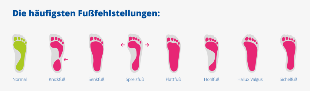 die häufigsten Fußfehlstellungen | MyGoal Training